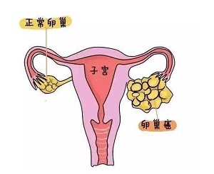 郑州治疗卵巢癌哪家中医馆好